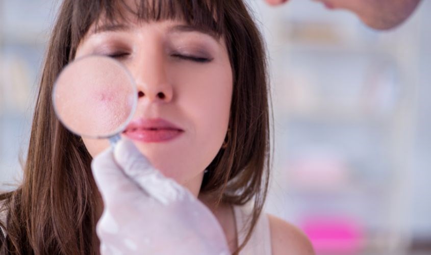 Cần ưu tiên điều trị da khi bị mụn nghiêm trọng trước khi tẩy da chết