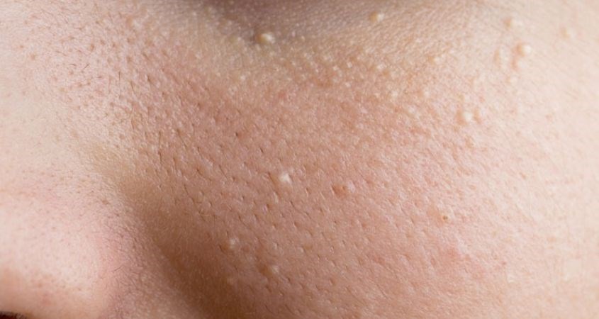 Mụn ẩn nằm dưới da, không lộ đầu nhân, ít gây sưng viêm nên rất khó để nhận biết