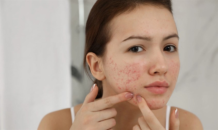 Thâm mụn là tình trạng da bị tổn thương và màu sắc da thay đổi sẫm hơn so với ban đầu.