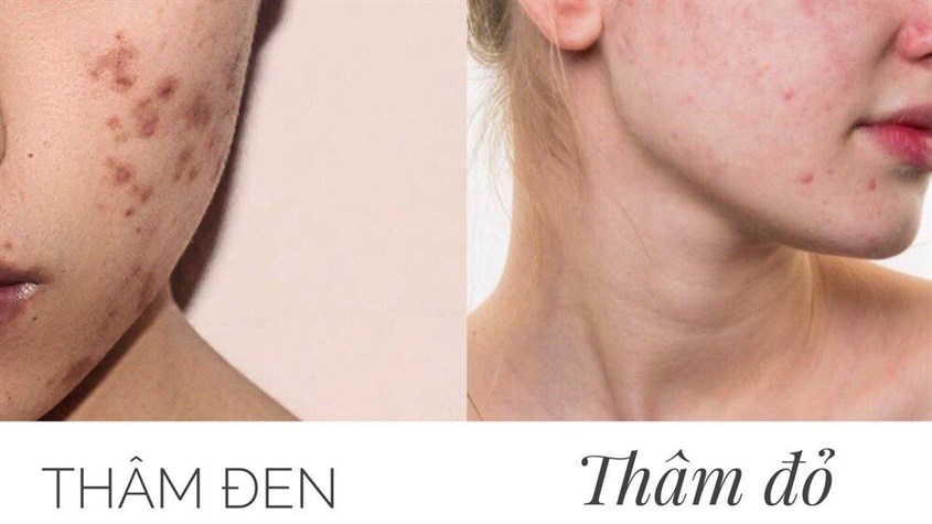 Có 2 loại thâm mụn phổ biến.