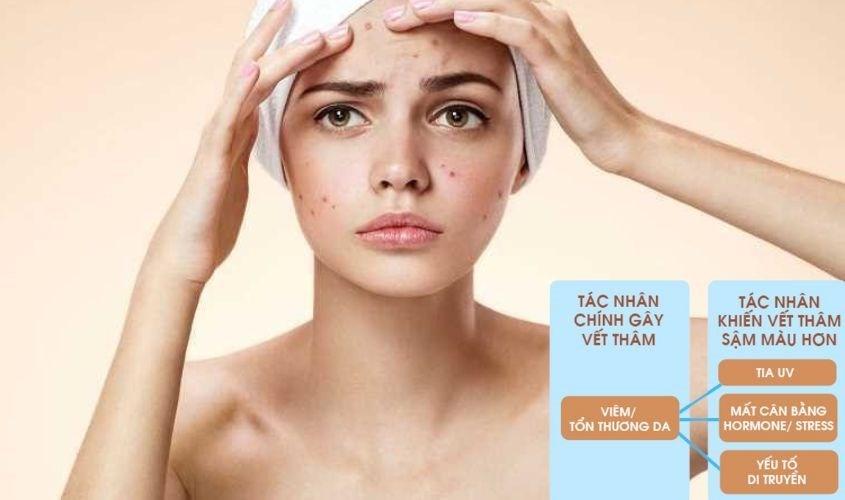 Tia UV cũng là tác nhân khiến vết thâm sậm màu hơn.