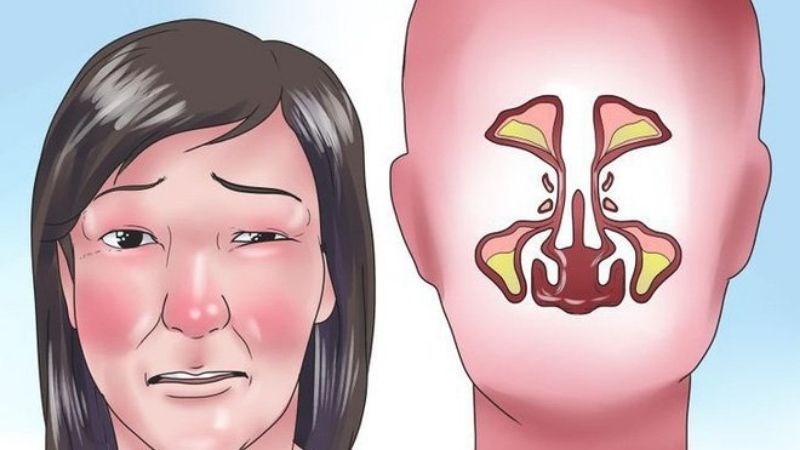 Viêm xoang gây nên tình trạng đau ở các vị trí xoang trên mặt