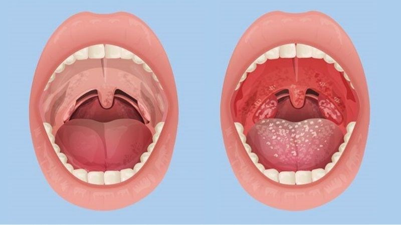 Nếu không điều trị kịp thời viêm xoang có thể dẫn tới viêm họng