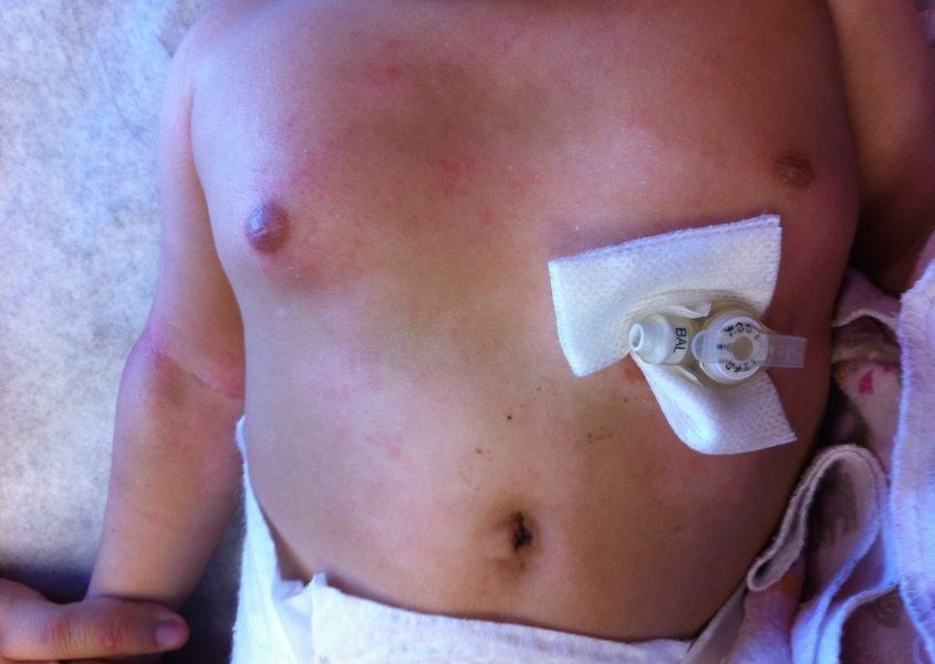 Khối u ở ngực thường xảy ra ở em bé nam nhiều hơn. Nguồn từ cloudfront