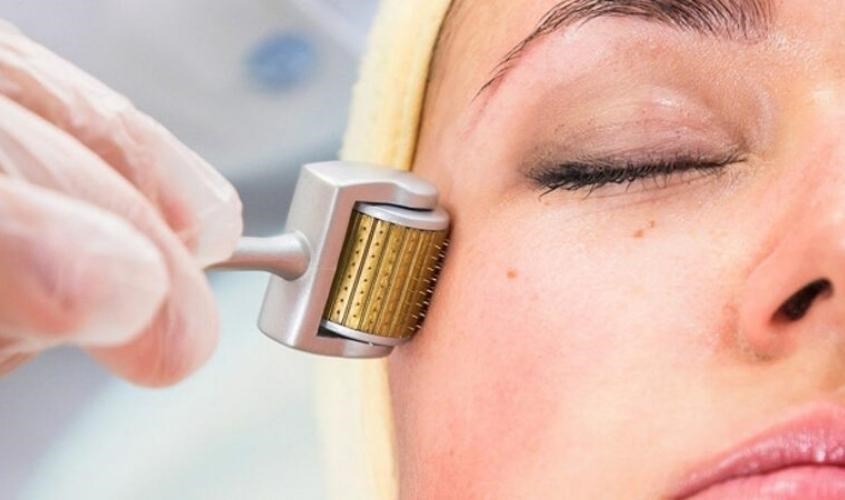 Liệu pháp cảm ứng collagen giúp trị sẹo rỗ hiệu quả