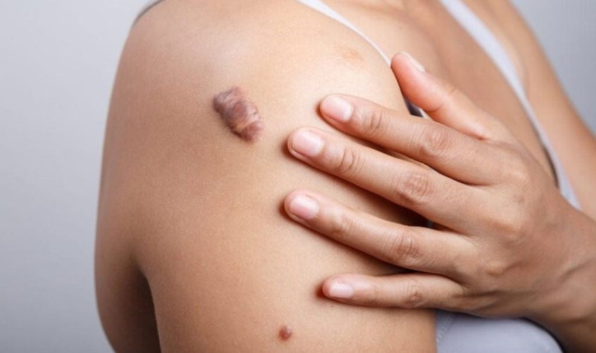 Sẹo lồi nổi lên bề mặt da do sản xuất collagen quá mức