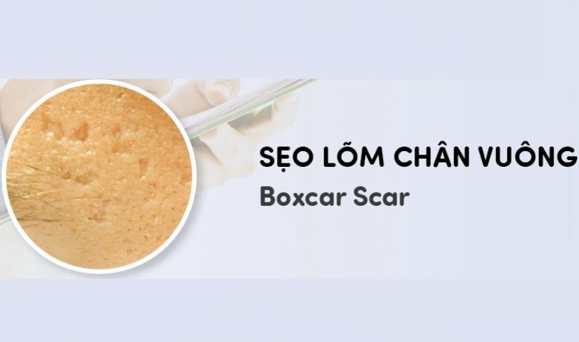 Sẹo lõm chân vuông có đáy vuông khá sâu