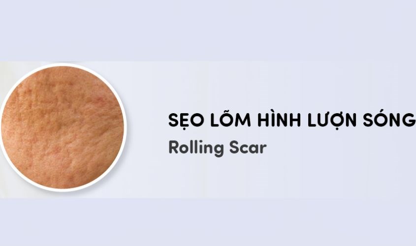 Sẹo lõm chân tròn có hình lượn sóng