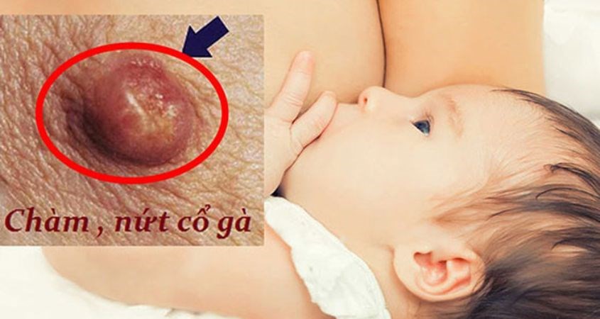 Thường xuyên sử dụng size phễu nhỏ cũng sẽ khiến mẹ bị nứt cổ gà