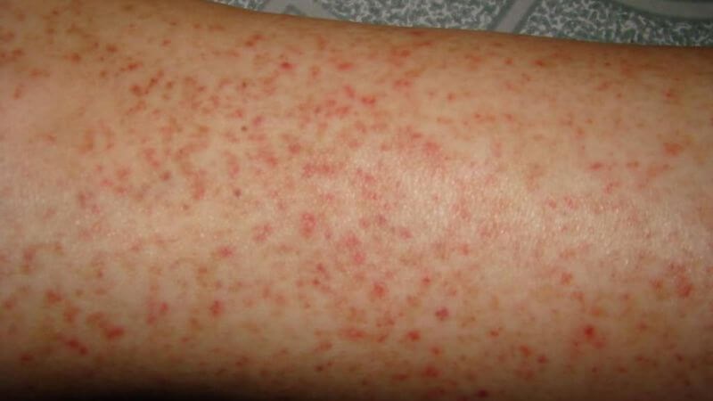 Nổi ban xuất huyết dưới da là dấu hiệu điển hình của bệnh Nổi ban xuất huyết dưới da là dấu hiệu điển hình của bệnh