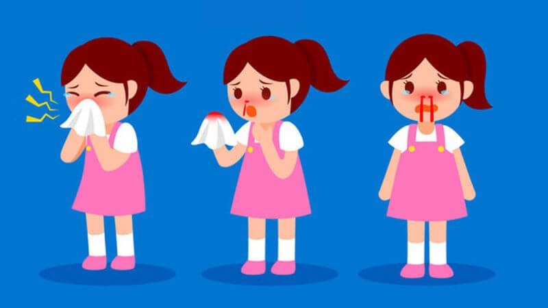 Chảy máu mũi nhiều là dấu hiệu cần đến gặp bác sĩ sớm Chảy máu mũi nhiều là dấu hiệu cần đến gặp bác sĩ sớm