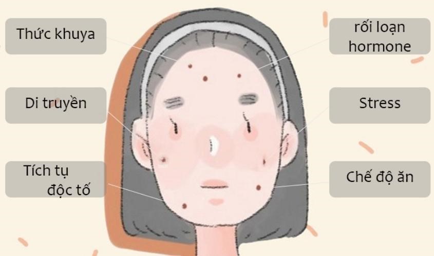 Có nhiều yếu tố khiến cho làn da bị mọc mụn