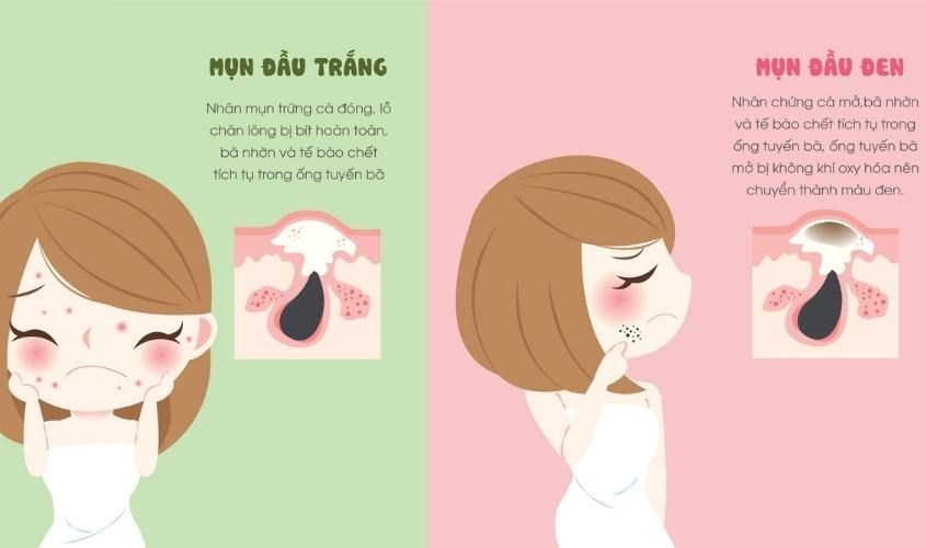 Có thể nặn mụn không viêm như mụn đầu đen và mụn đầu trắng