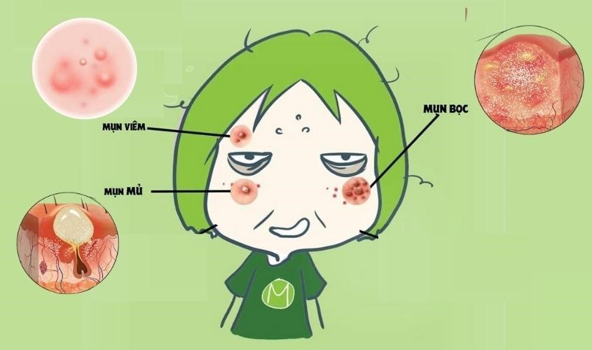 Không nên tự nặn mụn viêm vì chúng có thể khiến bạn bị mụn nặng hơn