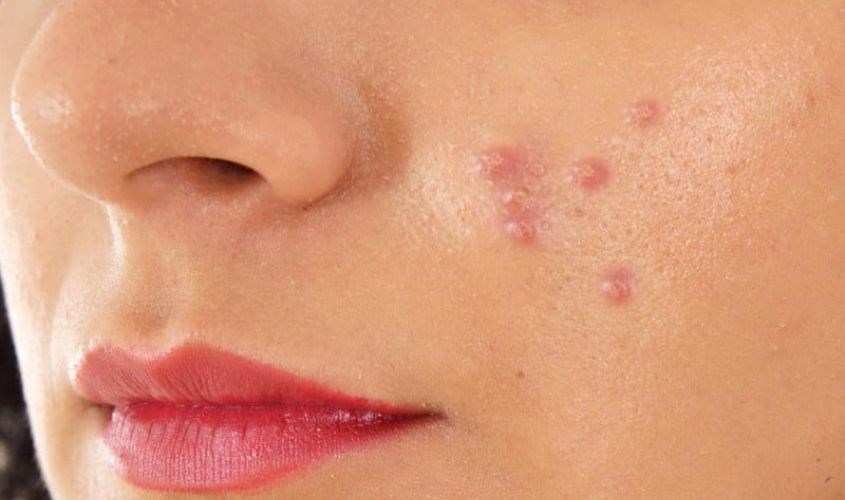 Không nên nặn mụn bọc vì sẽ để lại sẹo rỗ trên da nếu điều trị không đúng cách