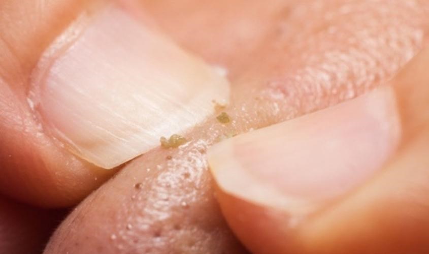 Không nên nặn quá gần ở gần vùng mụn đầu đen