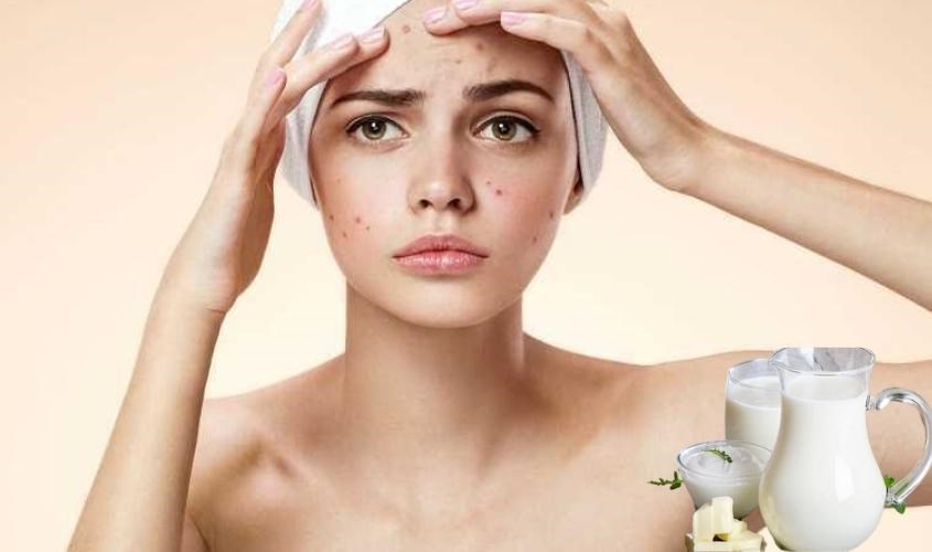 Da dầu mụn không nên rửa mặt vì sữa tươi có thể gây bí tắc lỗ chân lông