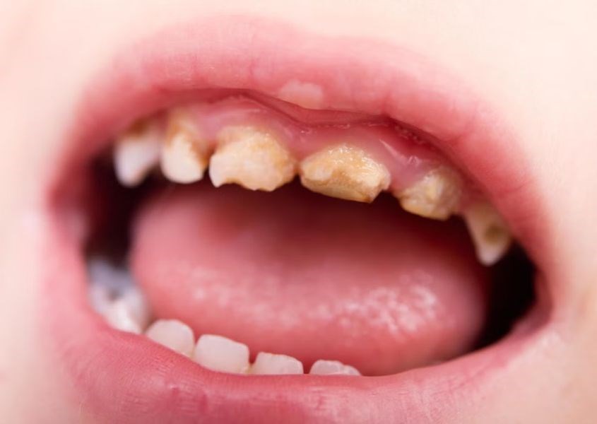 Điều gì làm ảnh hưởng đến quá trình mọc răng của trẻ mới biết đi? Nguồn từ independent