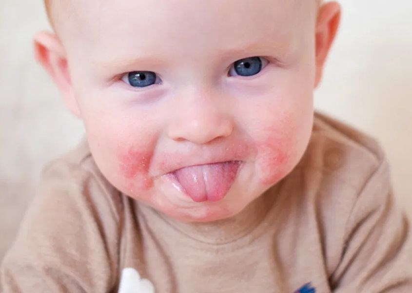 Trẻ mới biết đi chảy nước dãi rất nhiều trong quá trình mọc răng dẫn đến tình trạng phát ban quanh miệng. Nguồn từ i0.wp