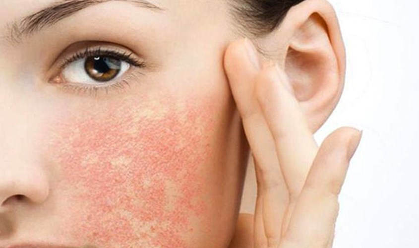 Dùng kem chống nắng không phù hợp có thể gây mụn 