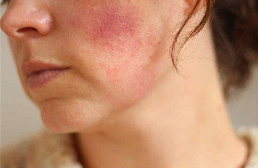 Dấu hiệu nhận biết da bị dị ứng kem chống nắng