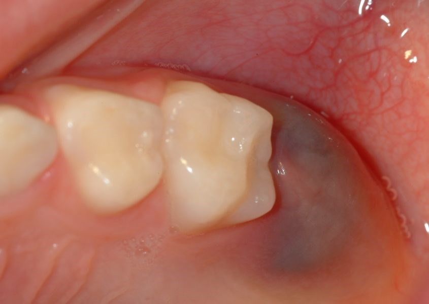 Tại vị trí răng mọc nhú lên của trẻ, nướu bị phồng hoặc lồi ra. Nguồn từ oralanswers