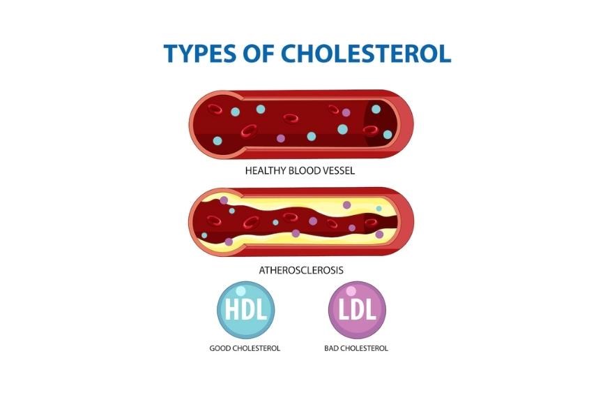 Cholesterol có hai loại: cholesterol LDL (lipoprotein tỉ trọng thấp) và HDL (lipoprotein tỉ trọng cao) (Ảnh: Freepik) Cholesterol có hai loại: cholesterol LDL (lipoprotein tỉ trọng thấp) và HDL (lipoprotein tỉ trọng cao) (Ảnh: Freepik)