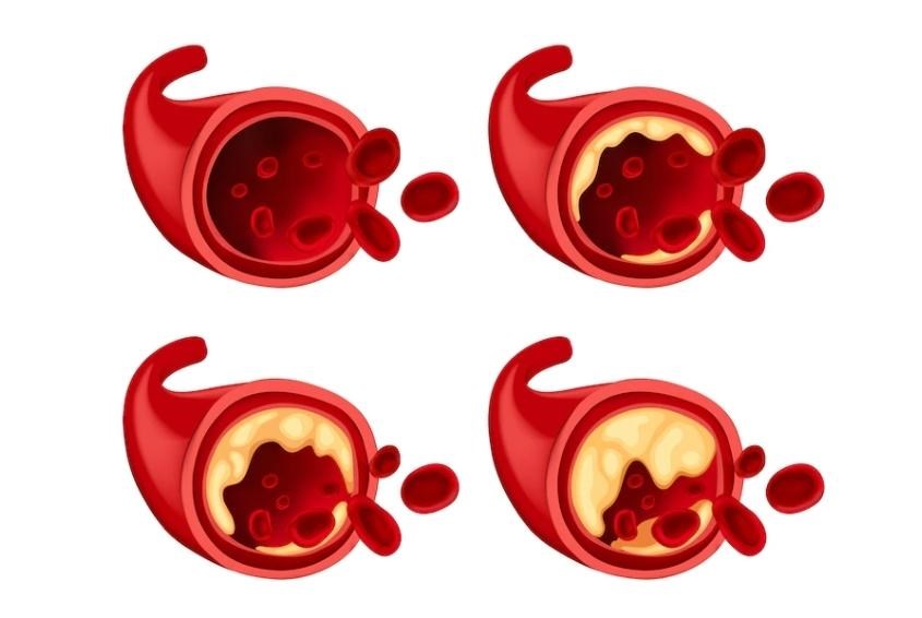 Nếu tắc nghẽn trong động mạch đến não, có thể gây ra đột quỵ (Ảnh: Freepik) Nếu tắc nghẽn trong động mạch đến não, có thể gây ra đột quỵ (Ảnh: Freepik)