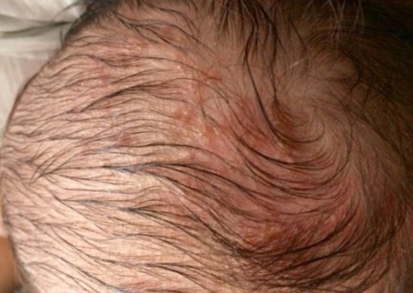 Bệnh chàm cũng là một nguyên nhân gây rụng tóc ở trẻ. Nguồn từ babycenter