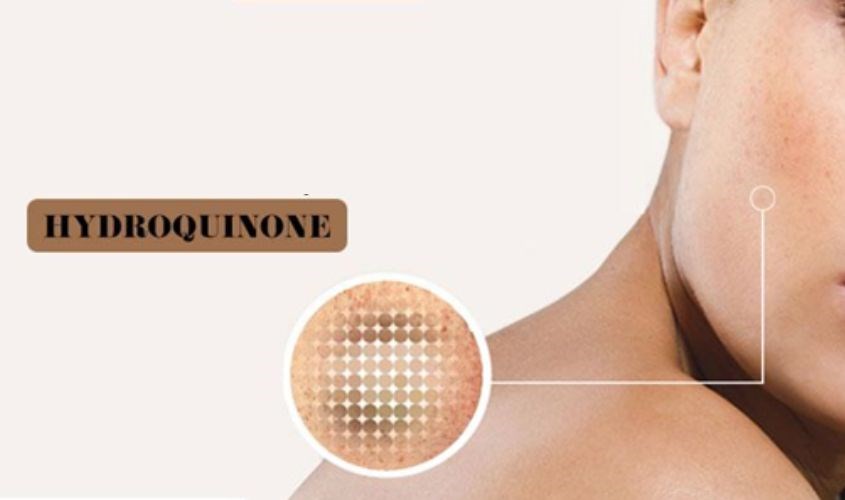 Hydroquinone là một hợp chất hữu cơ có tác dụng trị thâm nám, tàn nhang