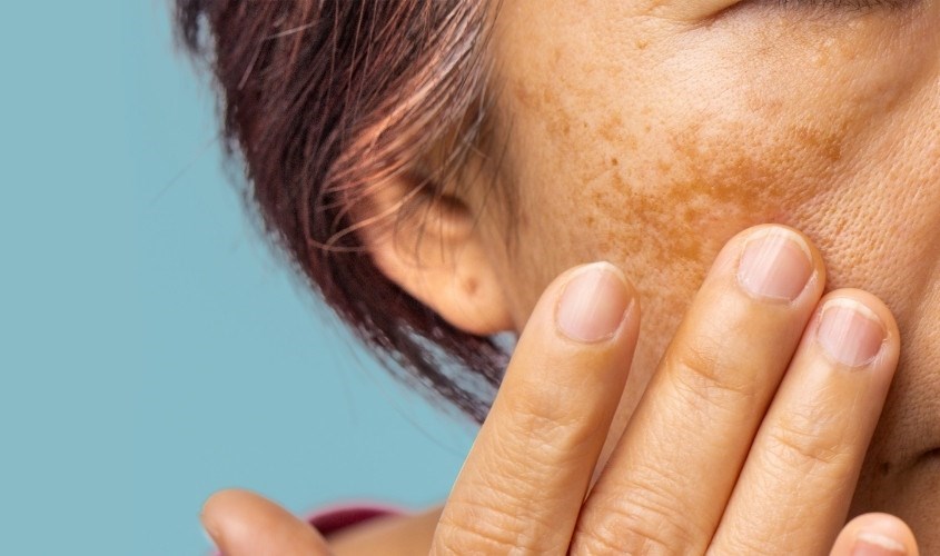 Melanin có thể gây ra tình trạng nám da