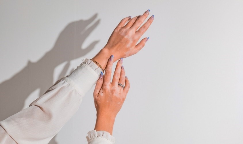 Melanin không xuất hiện ở những vùng da bị tổn thương do bỏng