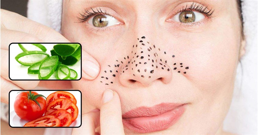 Một số lưu ý cho da mặt bị mụn đầu đen