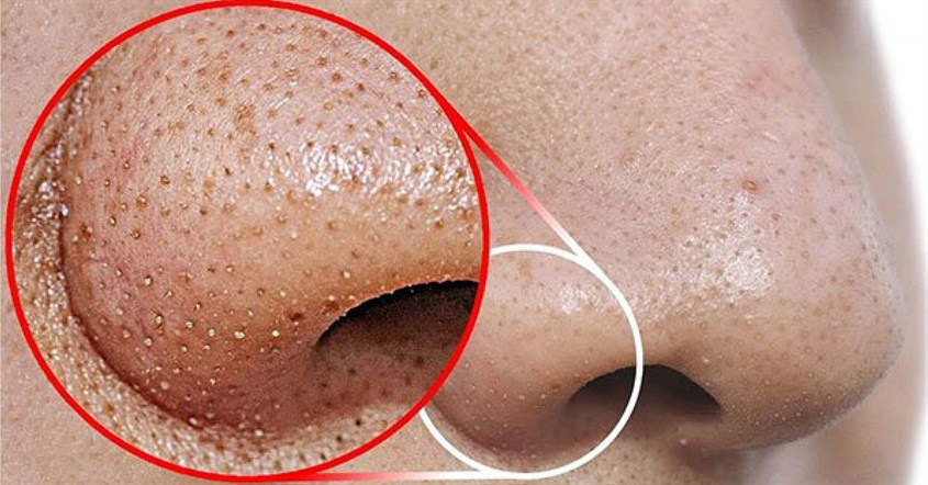 Đặc điểm của mụn đầu đen