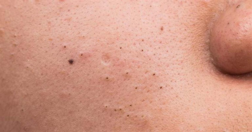 Thế nào là mụn đầu đen