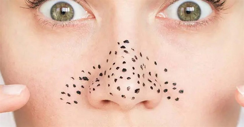 Dùng thuốc không qua tư vấn cũng là một nguyên nhân của mụn đầu đen