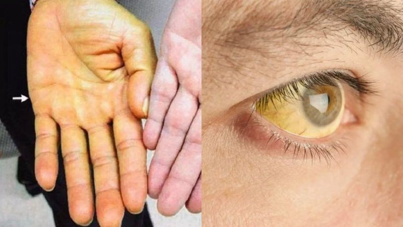 Vàng da, vàng mắt là dấu hiệu gan bị suy yếu