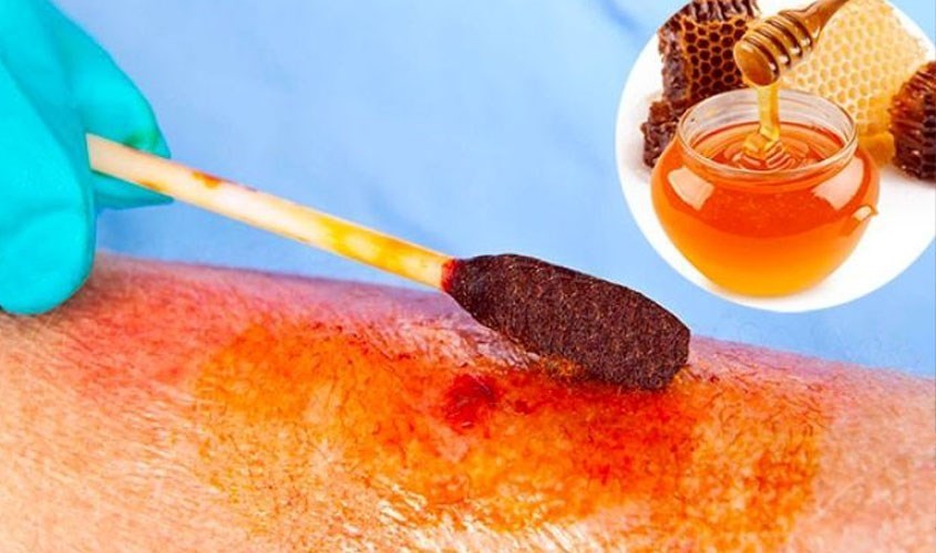 Mật ong giúp trị vết thương, vết bỏng Mật ong giúp trị vết thương, vết bỏng