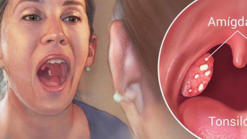 Viêm amidan gây đau ở cổ họng