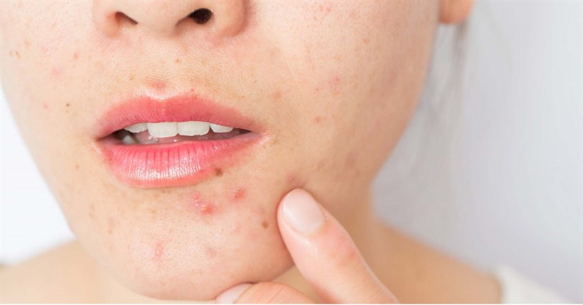 Yếu tố di truyền là một trong những nguyên nhân của mụn viêm