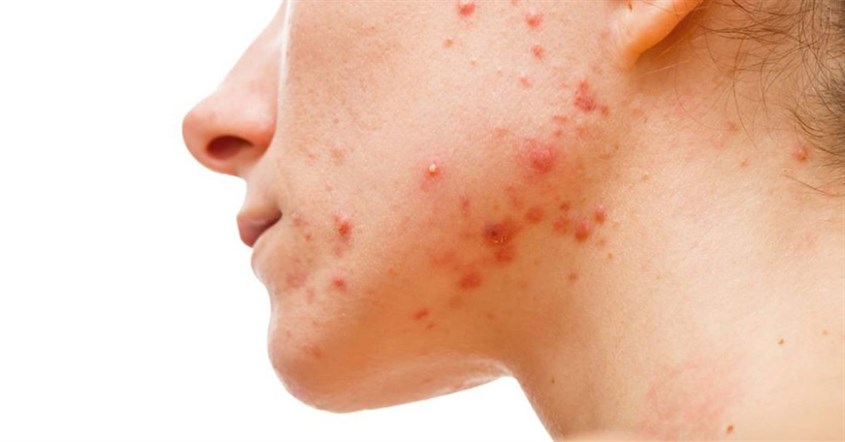 Da nhiễm nấm có thể dẫn tới mụn viêm