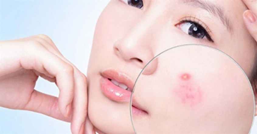 Một số biện pháp giúp ngăn ngừa mụn viêm