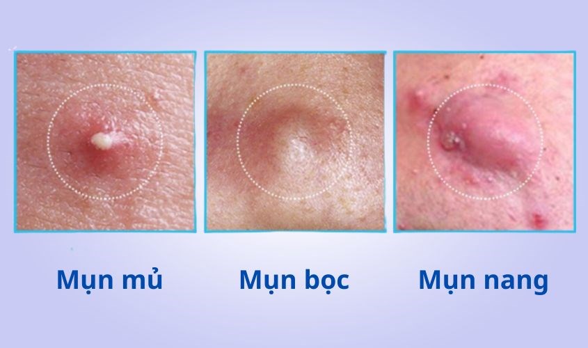 Các loại mụn viêm