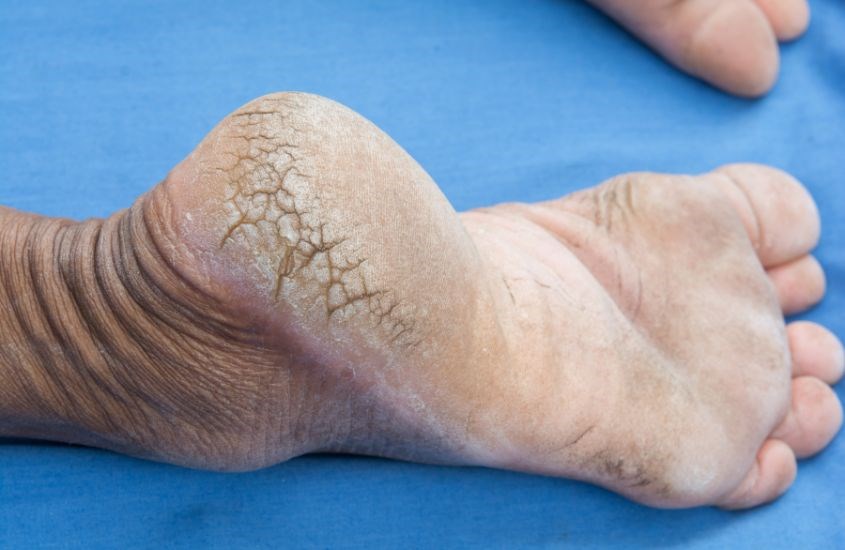 Nứt gót chân là bệnh lý rất phổ biến