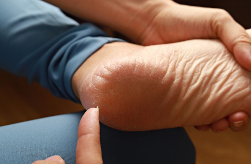 Nứt gót chân khiến da bong tróc và gây ngứa