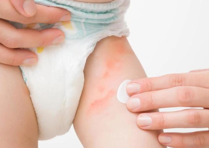 Nấm Candida là nguyên nhân chính gây nên tình trạng hăm tã do nấm men ở trẻ. Nguồn từ Consumer Healthday