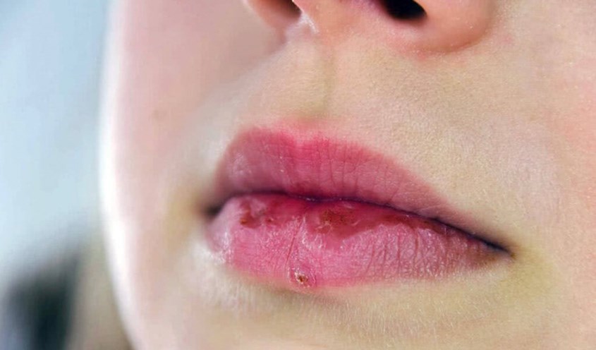 Không nên tẩy tế bào chết khi môi đang nứt nẻ chảy máu