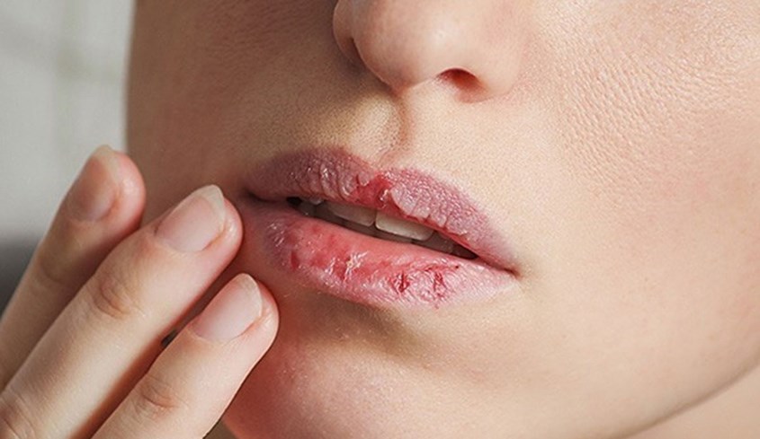 Mùa đông môi dễ bị khô và nứt nẻ nên tẩy tế bào chết môi 2 - 3 lần mỗi tuần