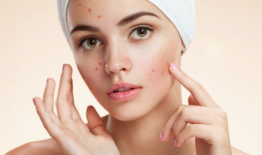 Mụn xuất hiện trên mặt do rất nhiều nguyên nhân Mụn xuất hiện trên mặt do rất nhiều nguyên nhân