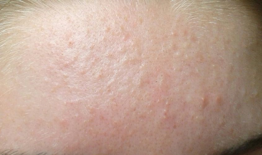 Mụn ẩn nổi li ti và không nhìn thấy nhân